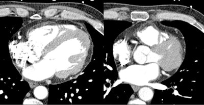 Arrythmogenic right ventricular dysplasia at CT. All images courtesy of Dr. Hans-Christoph Becker.