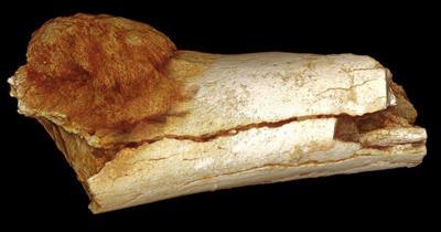 The fossil, a hominin fifth metatarsal, exhibits a hemispherical bony mass located on the proximoventral aspect of the shaft, abutting the cortical bone surface. Image courtesy of the South African Journal of Science.
