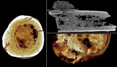 Top right: Axial micro-CT orthoslice indicating (i) reactive new bone formation subperiosteally forming a Codman triangle, (ii) ossified exophytic (cauliflower-like) and/or spiculated mass adjacent to the bone, (iii) localized subperiosteal invasion by the mass into the cortex, and (iv) remodeled bone infill. Left: Transverse rendered view of the bone. Images courtesy of the South African Journal of Science. Lower right: Transverse rendered view of a modern clinical case of osteoblastic osteosarcoma with aggressive local medullary infilling. Image courtesy of the University of Pretoria Department of Anatomy. Note the homologous combination of spongy and solid bone between the fossil and clinical specimens (v).