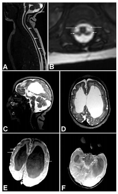 Spine and brain MRI of baby with arthrogryposis. A: Sagittal T2 weighted with fast imaging employing steady state acquisition (FIESTA) shows apparently reduced spinal cord thickness (short arrows) and mega cisterna magna (long arrow). B: Axial reconstruction of T2-weighted FIESTA shows reduction of medullary cone ventral roots (long arrows) compared with dorsal roots (short arrows). C: Sagittal T2-weighted image shows hypogenesis of corpus callosum (long white arrow), enlarged cisterna magna (long black arrow), enlarged fourth ventricle (short black arrow), and pons hypoplasia (short white arrow). D: Axial T2-weighted imaging shows pachygyria in frontal lobes (black arrows) and severe ventriculomegaly, mainly at posterior part of lateral ventricles. Axial susceptibility weighted image (E and F) show some hypointense, small dystrophic calcifications (white arrows) in junction between cortical and subcortical white matter (E) and in midbrain (F). All figures courtesy of the BMJ (2016;354:i3899, http://dx.doi.org/10.1136/bmj.i3899).