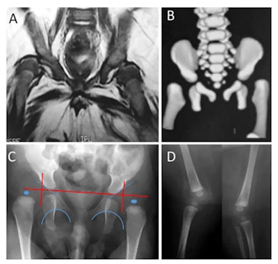 A: MRI shows bilateral dislocation of hips, epiphyseal core (small arrow), and dysplastic acetabulum (large arrow). B: 3D CT shows bilateral dislocation of hips. C: Anteroposterior radiographs show features compatible with dislocation of hips -- interruption of Shenton's arc, epiphysis hypoplastic proximal femoral acetabular index of 35°, and right and left proximal femoral epiphysis located laterally on side and bottom quadrant ombredanne. D: Radiograph shows subluxation of knee (arrows).