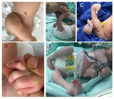 Clinical pictures of children with arthrogryposis. A: contracture in flexion of knee. B: hyperextension of knee (knee dislocation). C: clubfeet. D: deformities in second, third, and fourth fingers. E: joint contractures in legs and arms, without involvement of trunk.