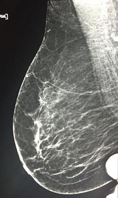 Rejected mammography images due to artifacts in the region of interest