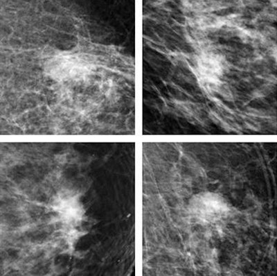 Top row: CNN correctly identifies breast malignancies. Bottom row: Benign findings misidentified by CNN as malignancies tended to be common abnormalities such as cysts that were easy for radiologists to exclude. Recognition of benign abnormalities will be built into future versions of the CNN. All images courtesy of Thijs Kooi.