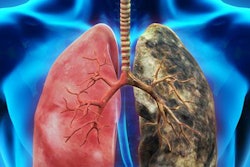 2016 08 17 08 21 28 156 Lung Cancer 20160817152303