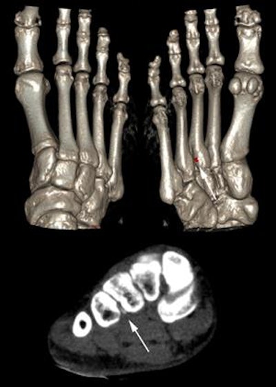 A 37-year-old patient presenting to the hospital with acute monoarthritis of the first metatarsophalangeal joint. Uric acid levels were elevated. The radiograph showed no changes, especially no erosions or gouty tophi. Doubt about the diagnosis of gout arose due to the young age of the patient. Dual-energy CT, however, depicted a small tophus at the third tarsometatarsal joint, which can easily be missed on conventional CT (arrows), confirming the diagnosis of tophaceous gout. Image courtesy of Dr. Torsten Diekhoff.