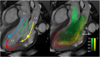 Schematic of the routes of the four LV flow components: direct flow (green), retained inflow (yellow), delayed ejection flow (blue), and residual volume (red). A semitransparent grayscale three-chamber image provides morphological orientation. Circles indicate the approximate location of the center of mass of each component at the time of end-diastole. Particle trace pathlines indicate routes of direct flow (green) and retained inflow (yellow). Red dots indicate the positions of the residual volume pathlines at end-diastole. Nonejected flow comprises the retained inflow and the residual volume. Ao, aorta; LA, left atrium; LV, left ventricle. Image republished with permission of PLOS One, 17 August 2016.