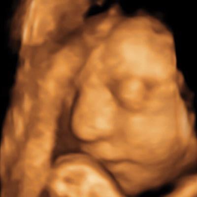 A 3D ultrasound image obtained at 30 weeks in the case of a 34-year-old woman with confirmed Zika virus infection, initially seen for a rash at eight weeks of gestation. Image of the face shows a sloping forehead, compatible with frontal lobe hypoplasia. All images courtesy of Radiology.