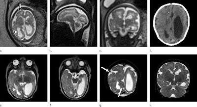 (a) Axial, (b) sagittal, and (c) coronal fetal T2-weighted MR images were obtained in a 29-year-old woman with confirmed Zika virus infection, initially seen for characteristic rash at 12 weeks of gestational age. (d) Axial postnatal CT image and (e-g) axial and (h) coronal T2-weighted MR images were obtained in her neonate. The fetal MR images obtained at 34 weeks (a-c) show asymmetrical ventriculomegaly with a septation in the right occipital horn (arrowhead on a), small frontal lobes, thinning of the occipital parenchyma (left worse than right), underdeveloped sylvian fissures, and regions of thickened cortex, as in the right frontal lobe, which is suggestive of polymicrogyria (arrow on a). There is abnormal, increased signal intensity in the white matter. The postnatal CT image (d) obtained in the 22-day-old neonate shows punctate calcifications at the gray matter-white matter junction and asymmetrical ventriculomegaly. The T2-weighted MR images obtained at 26 days (e-h) show septation in the ventricle (arrowhead on e). Note how the right ventricle has relatively decreased in size compared with the prenatal image, whereas the left ventricle has increased in size. Underrotation of the hippocampus (arrowheads on f) is demonstrated. There is clear asymmetry of the gyral pattern on g, which is relatively smooth in the left occipital region, with abnormal folds in the right occipital and frontoparietal regions (arrows on g). Subependymal cysts are visualized on h, which are not seen on fetal MR images.