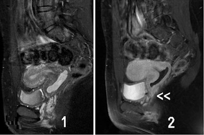 Urogenital sinus anomalies. MR images [(1) T1- and (2) T2-weighted fat-suppressed images in the sagittal plane] show a retrovesical blind vagina with apparent inferior half atresia and undetected fistula tract to the bladder (