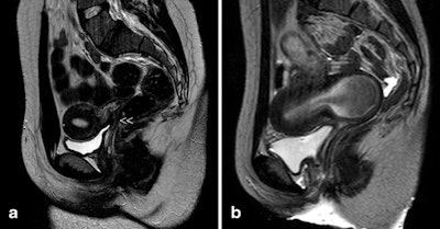 Cases with vaginal or cervicovaginal atresia or agenesis and normal uterine corpus. A: T2-weighted MR image in a 20-year-old woman with complete cervicovaginal atresia. Medial sagittal section showing the uterus and cervicovaginal atresia (