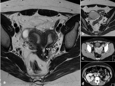 A 32-year-old woman with complete unilateral vaginal or cervicovaginal agenesis or atresia and huge endometrioma. A: T2-weighted MR image shows a bicornuate (transitional or bicorporeal septate) uterus with communication at the isthmic level (