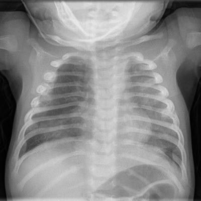 An example of a pediatric chest x-ray. Image courtesy of Dr. David Howlett, PhD.