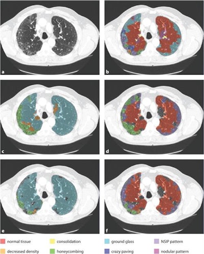 An example axial slice (a) that was annotated by observer A (c) and observer D (d), with low interobserver agreement; automatic classification results (b); interactive classification results after training on at least 50% of all VOIs in the scan annotated by observer A (e); and interactive classification results after training on at least 50% of all VOIs in the scan annotated by observer D (f).