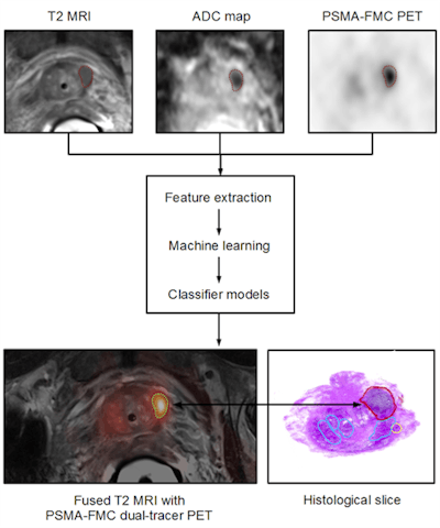 Figure 6: Patient with prostate cancer undergoing dual-tracer PET/MRI and subsequent ex vivo histopathology of the prostate. Combined PET/MRI includes T2-weighted MRI for anatomical referencing, Diffusion weighted imaging (DWI) for estimating cellular density and sequential Ga-68 PSMA and F-18 FCH imaging. Multiparametric image data processing supports the extraction of specific image features that are entered into a machine-learning (ML) process and subsequent computer-supported classifiers, which, based on sufficient and validated training efforts, permit the delineation and classification of tumor heterogeneity. Image courtesy of Laszlo Papp and Dr. Markus Hartenbach, Medical University Vienna, Austria.