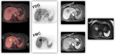 Figure 1: Dual tracer, multiparametric PET/MRI using F-18 FDG and F-18 FMC for noninvasive tumor characterization in a 70-year-old patient with suspected hepatocellular carcinoma (based on EORTC-criteria) prior to resection. Image courtesy of Dr. Markus Hartenbach, Medical University Vienna in Austria.