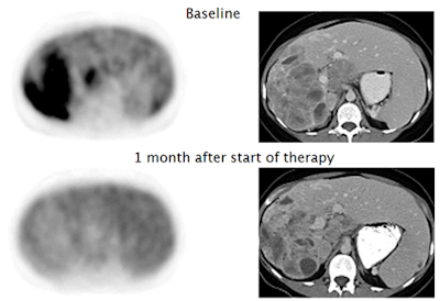 Figure 2: Patient with gastrointestinal stromal tumor (GIST), showing early metabolic response to Imatinib therapy (F-18 FDG PET, left side), without change in size of the tumor (CT, right side). Panels modified from (4).