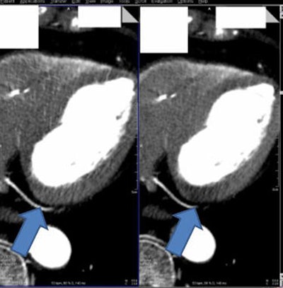 Myocardial CT image (above right) reconstructed without beam hardening correction kernel. Distinct beam-hardening artifact, mimicking hypodensity, such as found in myocardial infarct, is visible. The inhomogeneous dorsal wall of the left ventricle represents a possible myocardial infarct. The patient cannot be discharged and undergoes further (possibly) invasive examinations. Image above left shows same anatomy with beam-hardening correction algorithm applied. Homogeneous dorsal wall of the left ventricle confirms no myocardial infarct. With a high certainty in diagnosis, the patient can be discharged. Images below and bottom depict iodine maps of the same anatomy with no beam-hardening correction applied. All images courtesy of Drs. Albrecht Moritz and U. Joseph Schoepf.