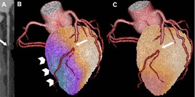 Cardiac hybrid image showing a matched hybrid finding with a stenosis in the LAD (arrow: A = multiplanar reconstruction of a CT coronary angiography) causing a perfusion defect at stress (arrowhead: B), which is reversible at rest (C). All images courtesy of Dr. Aju Pazhenkottil.