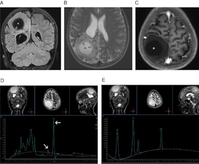 A: Coronal fluid attenuation inversion-recovery (FLAIR) MRI of the brain showing a large, well-defined, unilocular, cerebrospinal fluid-like cyst (*) located in the right parietal lobe. The cyst is causing minimal mass effect on the occipital horn of the right lateral ventricle (arrow) with mild surrounding vasogenic edema. Collapsed membranes are seen in the medial and inferior aspect of the cyst (open arrows). B: Axial T2-weighted MRI of the brain showing the right parietal hyperintense hydatid cyst (*). The cyst has a thin hypointense rim (arrow) with mild surrounding vasogenic edema along its anterior aspect. Collapsed membranes are seen in its medial aspect with a ball-of-wool pattern (open arrows). C: Axial T1-weighted MRI of the brain after gadolinium administration showing the right parietal hypointense hydatid cyst (*) with the nonenhancing collapsed membranes seen in its medial aspect. D: Single-voxel MR spectroscopy from the central cystic portion of the lesion showing increased choline, a small peak at 2.40-2.50 ppm representing pyruvate and succinate (oblique arrow), and a large abnormal peak at 2.2 ppm representing glutamate/amino acids (horizontal arrow). Pyruvate and succinate are well-known metabolic end products arising from microorganisms. E: Single-voxel MR spectroscopy from the peripheral solid portion of the cystic lesion showing increased choline/N-acetyl aspartate ratio. All images courtesy of BMJ Case Reports.