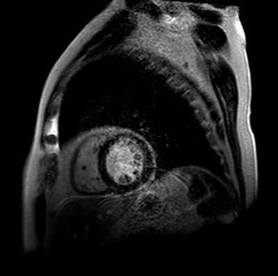 This CMR image with late gadolinium enhancement shows thin subendocardial scar in the anterior segment.
