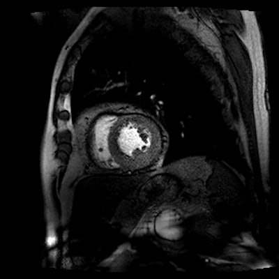 First-pass stress perfusion CMR image shows hypoperfusion (ischemia) in the septum and anterior wall. Images courtesy of John P. Greenwood. PhD.