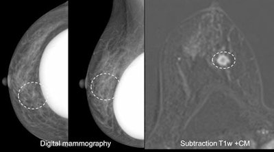 Case 3: A 51-year-old woman with discharge on the left side and a suspected papilloma on the left side. Problem-solving MRI revealed a carcinoma on the right side BI-RADS 5 that was missed both by mammography and ultrasound.