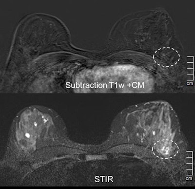 Case 2: A 47-year-old woman with new palpable finding in the left lateral breast with architectural distortion in ultrasound, no suspicious microcalcifications. Problem-solving MRI showed no enhancement in the indicated region, thereby excluding malignancy. STIR = short tau inversion recovery.