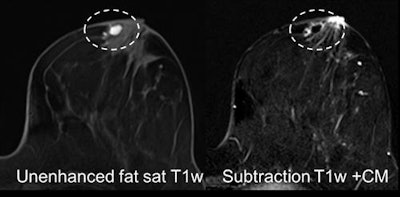 Case 1: On a 44-year-old woman, MRI was performed for problem-solving due to suspicious lesion left side retroareolar region, several similar lesions on ultrasound, appearing hypoechogenic with dorsal acoustic shadowing. MRI shows dehydrated proteinaceous fluid on precontrast T1-weighted imaging, after contrast media injection a periductal enhancement. This is typical periductal mastitis and cancer could be excluded. All images courtesy of Dr. Pascal Baltzer.