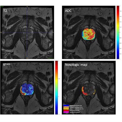 Figure 1. Multivariate analysis of prostate cancer from MR diffusion and perfusion acquisitions and generation of nosologic map by Euclidean-normalized algorithms.