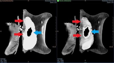 Comparison of a conventional CT image (left) with IQon image (right). The observed density in the conventional CT image is caused by the pyrite infill visible between the spinal canal and the main body of the vertebra, but is removed in the IQon spectral CT image. This reveals not only bone structure (red arrows), but also the structure of the pyrite infill (blue arrows).