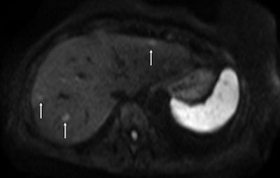 On the diffusion-weighted image, the same lesion is seen as well as two additional metastases: one in the right liver and one in the left liver. All metastases are strongly hyperintense compared to the background liver at b = 600 sec/mm2, indicating restricted diffusion. All of these lesions were surgically confirmed as metastases.