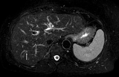 Fat-suppressed T2-weighted fast spin-echo MR image obtained in 61-year-old man with liver metastases from colorectal cancer. Only one metastasis in the right liver lobe is seen on this slice (arrow). Moreover, this lesion is barely seen because it is located next to a vessel. Images courtesy of Dr. Valérie Vilgrain, PhD.
