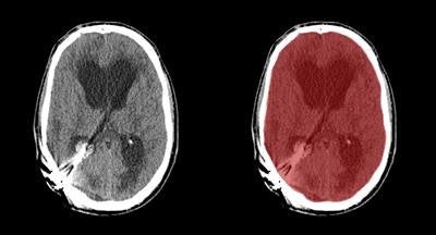Axial view of final cranial cavity segmentation for patient with drain inserted in enlarged intraventricular space. All images courtesy of Ajay Patel.