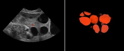 Follicles in the ovary evaluated on B-plane image of the ovaries (left). Inversion rendering (right) clearly shows the total number of follicles in the ovary.