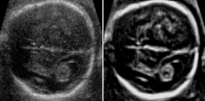 Fetal brain on an A-plane image before volume enhancement (left) and after adaptive volume enhancement was applied to the raw image volume (right).