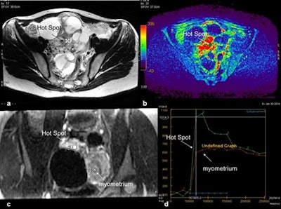 Technical assessment of dynamic contrast-enhanced MR imaging in complex adnexal masses. This example shows a complex right ovarian mass with a solid component in intermediate T2-weighted signal (a) that heterogeneously enhances after gadolinium injection. Parametric map (maximal slope) helps to determine the most suspicious location (hot spot) where the region of interest should be placed to build the time-intensity curve (b). To compare this curve with the myometrial curve, 3D T1-weighted sequence must be reformatted in the coronal plane to place the two regions of interest (solid component and external myometrium) (c). Comparison of time-intensity curves shows the solid component enhances according to a time-intensity curve type 3 (curve steeper than that of myometrium).