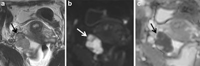 Ovarian carcinoma confined to the right ovary (arrow) displaying intermediate signal intensity on T2-weighted imaging and restricted diffusion characterized by high signal intensity on the high b-value (b = 1,200) image and loss of signal on apparent diffusion coefficient. All images courtesy of Dr. Rosemarie Forstner.