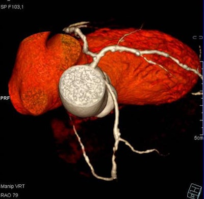 Fifty-three year-old male with acute chest pain. CCTA reveals a mean lumen area of 1.9 mm3, 80% area, 55% diameter stenosis, and anomalous right coronary artery arising from the left coronary sinus. Image courtesy of Dr. Gudrun Feuchtner.