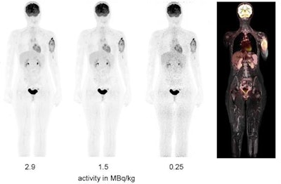 FDG-PET/MRI of a 16-year-old girl with osteosarcoma of the left humerus. A simulated tracer activity of 1.5 MBq/kg shows good diagnostic PET quality comparable with the originally injected activity of 2.9 MBq/kg. Further reduction to 0.25 MBq/kg results in markedly reduced PET image quality. The right panel shows fusion of PET and coronal MR images.