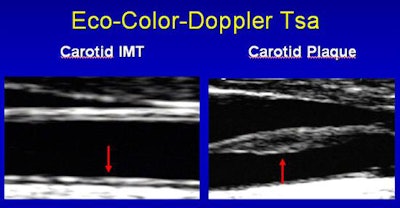Above, ultrasound finds carotid disease. Images courtesy of Dr. Andrea Igoren Guaricci.