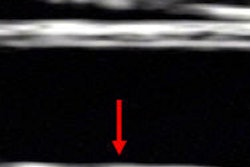 2016 10 31 12 00 53 665 2016 10 31 Ultrasound Carotids Thumb