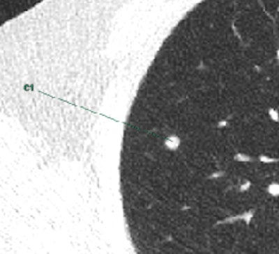 Marking of a CAD-software-detected solid nodule in the right upper lobe in ultralow-radiation-dose CT (0.15 mSv). All images courtesy of Dr. Michael Messerli.
