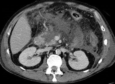 About two-thirds of patients with infected necrosis must be treated surgically.