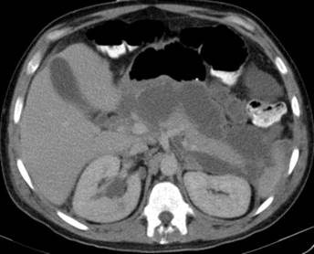 When you see a peripancreatic collection, then describe where it is and outline its characteristics in detail. Clinical images courtesy of Dr. Thomas Bollen.