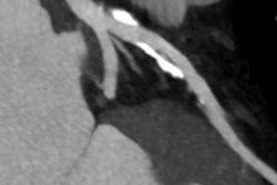 2016 11 08 12 34 48 600 2016 11 09 Achenbach Clinical Image Calcifications 20161108193528