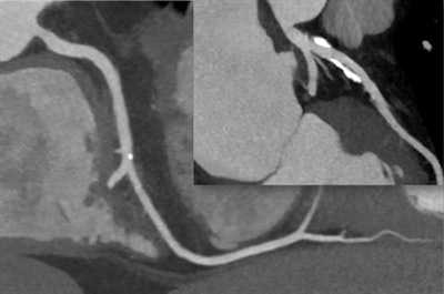 CT scan shows two separate coronary arteries without stenosis or narrowing. There is calcification, and if CT is not performed well (high motion, low-quality image), these calcifications can cause false-positive findings. Image courtesy of Dr. Stephan Achenbach.