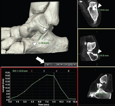 Postprocessing tool user interface. Software allows positioning of various reference markers in any bony structure of study area (arrowheads). Time controls (arrow) allow visualization of all available volumes of dynamic acquisition. Once reference markers for distances (green lines) or angles (not shown) are set, software automatically projects them to all volumes acquired. After analysis, variation of measurement performed in acquisition volumes is displayed graphically (red rectangle). Data can also be exported for further analysis. All images republished with permission from AJR.