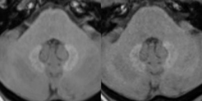 Unenhanced T1-weighted MR images at 3 tesla depict a patient with pre-existing hyperintensities in the dentate nucleus. The left image displays the cerebellum prior and the right image after five serial injections of the macrocyclic GBCA Gadavist. A subtle decrease of the pre-existing hyperintensities can be noted. Images are courtesy of Dr. Alexander Radbruch.