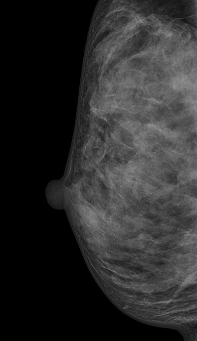 Digital mammogram of an ACR 4 dense breast.